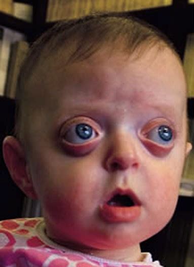 Pfeiffer syndrome - Pictures, Types, Symptoms, Causes, Treatment