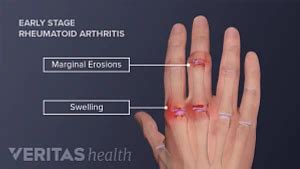 Hand Pain and Rheumatoid Arthritis | Arthritis-health