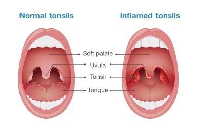 Normal Throat Bumps