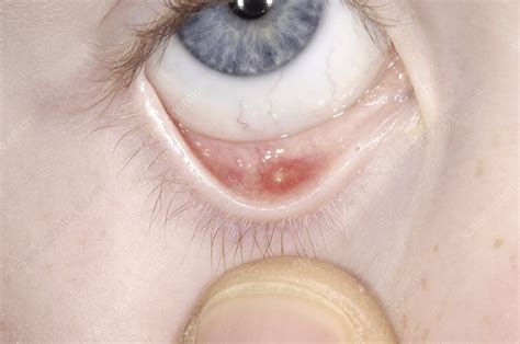 Cyst (chalazion) on eyelid - Stock Image - M155/0595 - Science Photo Library