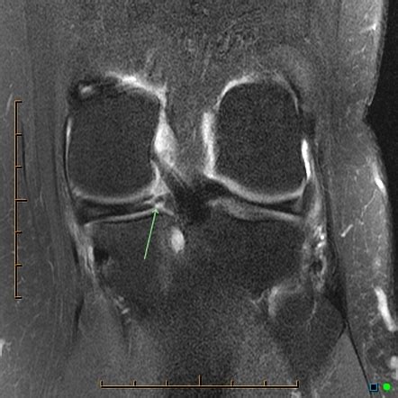 Meniscal root tear | Radiology Reference Article | Radiopaedia.org