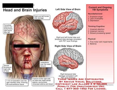 Frontal Lobe Brain Injury. | Brain injury, Brain injury awareness, Frontal lobe