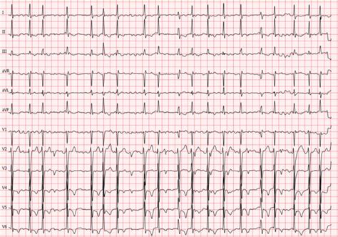 Resting ECG at admission. Tachycardic atrial fibrillation with ...