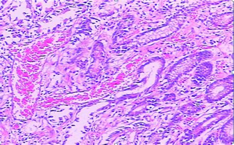 Case report of gastric antral vascular ectasia (GAVE)