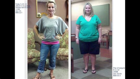 Gastric bypass success story - plantstorm