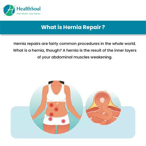 Hernia Repair: Indications and Complications – Healthsoul