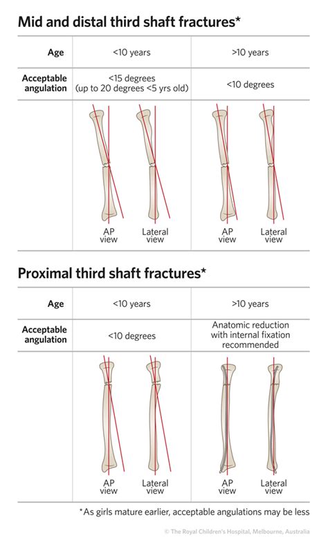 Fracture - radius and ulna shaft (diaphyseal) fractures