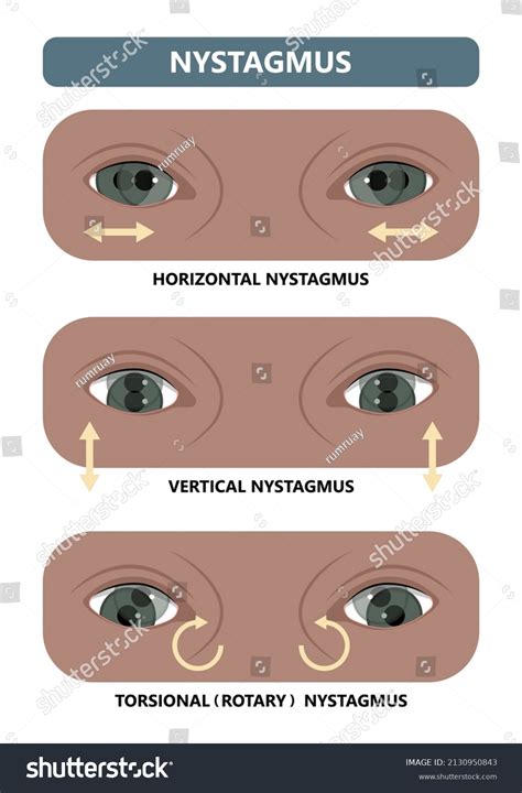 200 Nystagmus? Bilder, Stockfotos und Vektorgrafiken | Shutterstock