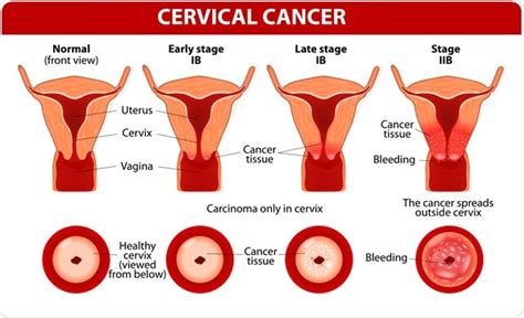 HPV and Cervical Cancer