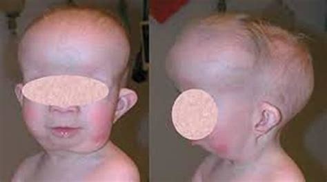 Gorlin syndrome causes, symptoms, diagnosis, treatment & life expectancy