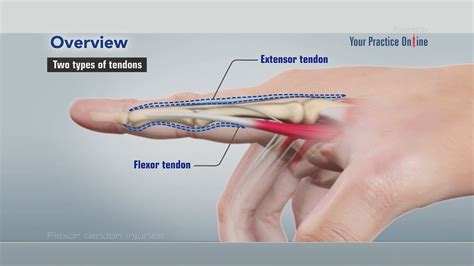 Extensor tendon repair post-surgery progress - Week 1 to 14 - YouTube