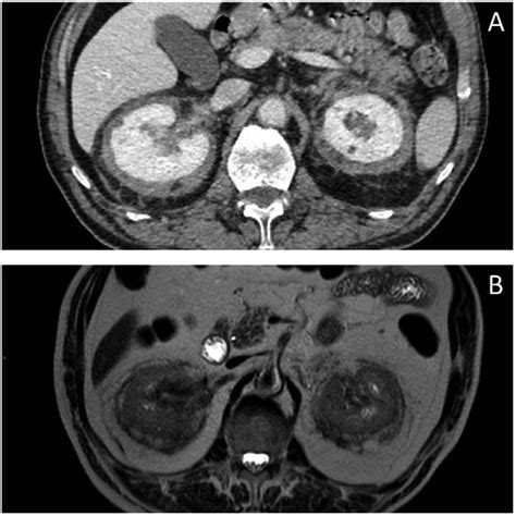 -Abdomen CT pretherapy, abdomen MRI posttherapy. (A) Proliferative... | Download Scientific Diagram