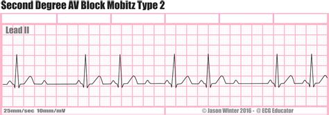 Second Degree Heart Block Ekg