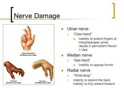 Resultado de imagen de ulnar radial flexio extension | Median nerve ...