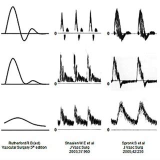 Triphasic (A), biphasic (B), and monophasic (C) Doppler waveforms ...