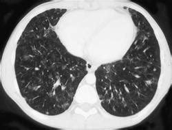 Eosinophilic Pneumonia - Chest Case Studies - CTisus CT Scanning