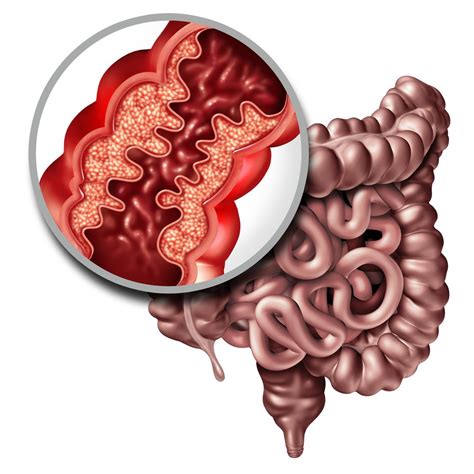 Crohn’s Disease : Overview, Causes, Symptoms, Treatment - illness.com