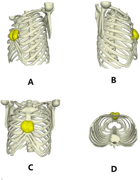 Three dimensional reconstruction images of the chest wall. | Download ...