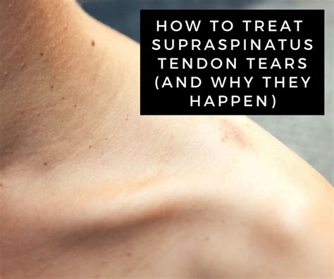 A Guide to Supraspinatus Tendon Tears (Rotator Cuff Injury) - YouMeMindBody