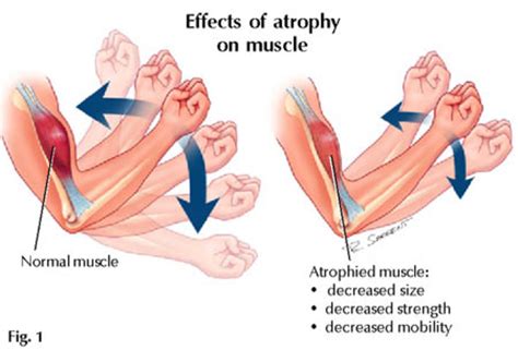 Are you Suffering from Muscle Atrophy? | HubPages