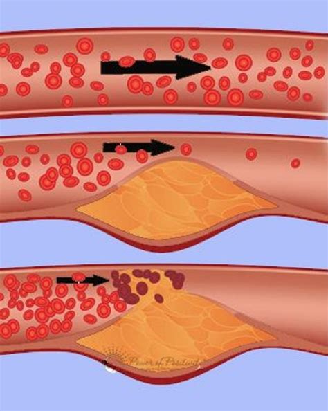 Here Are Some Warning Signs And Symptoms Of Blocked Arteries And Preventive Measures To Consider ...