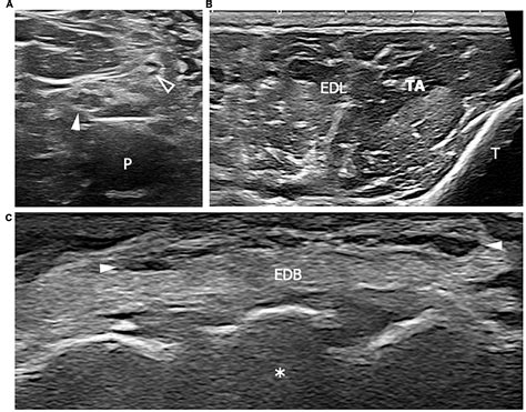 Frontiers | High-resolution ultrasound of peripheral neuropathies in ...