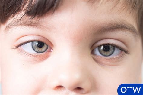 Lazy Eye (Amblyopia): Causes, Symptoms, Diagnosis, and Treatment