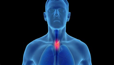 Esophageal Cancer X Ray