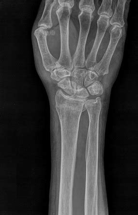 Colles Fracture X Ray