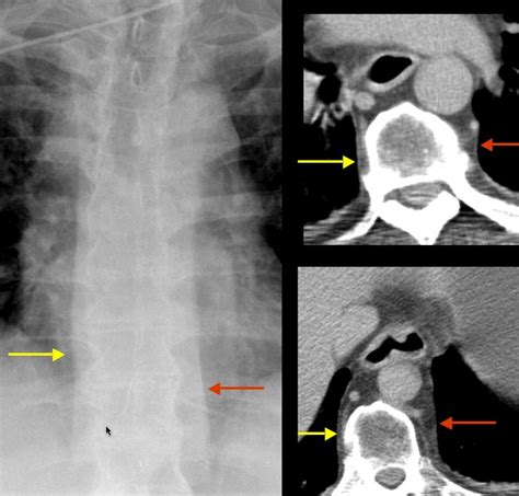 Paraspinal Line - paraspinal (also known as the paraspinous or ...