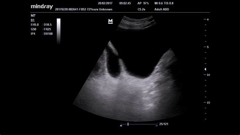 Ultrasound bladder diverticulum - YouTube