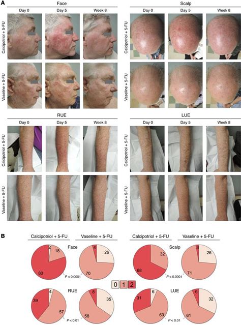 JCI - Randomized trial of calcipotriol combined with 5-fluorouracil for skin cancer precursor ...