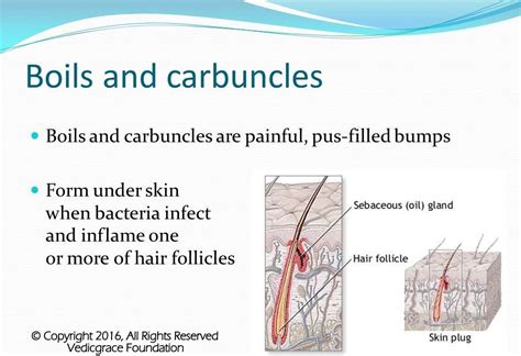 Carbuncle Vs Furuncle