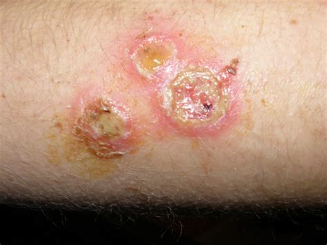 Staph Infection After A Burn - Northeast School of Botanical Medicine