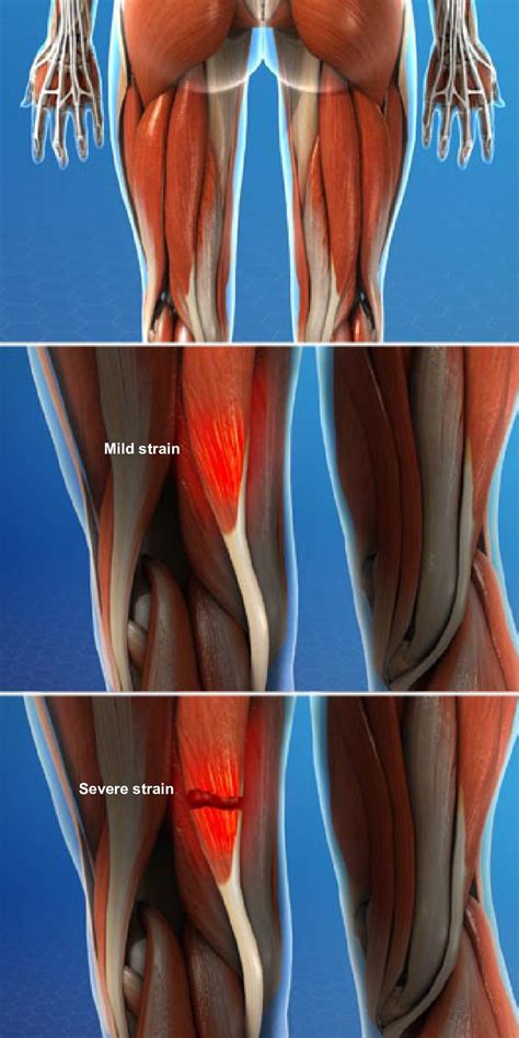 Muscle Strain Injuries of the Thigh - Dr. Mark Tuttle