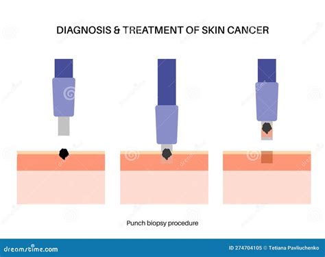 Punch biopsy procedure stock vector. Illustration of tissue - 274704105