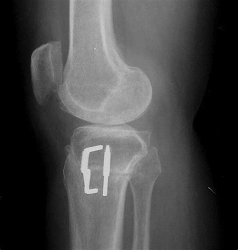 The complications of high tibial osteotomy | Bone & Joint