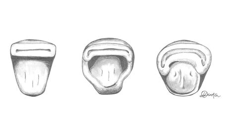 3. Occlusal view of morphological variation in shovel-shaped incisors.... | Download Scientific ...