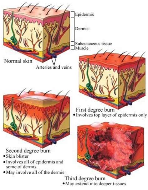 Guide to Burn Degrees: Shows how the skin reacts to varying levels of ...