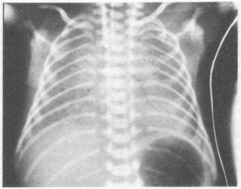 A Comparison of Early-Onset Group B Streptococcal Neonatal Infection and the Respiratory ...