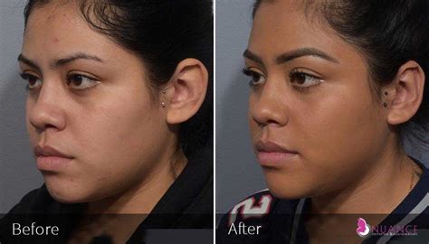 Ear Reshaping Surgery (Otoplasty) in Las Vegas, NV | Nuance