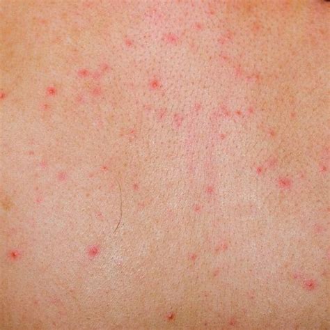 Red Spots On Shoulders