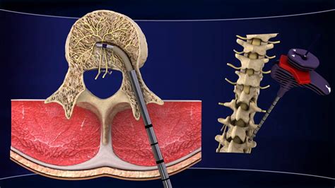 INTRACEPT Intraosseous Nerve Ablation System - YouTube