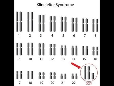 Klinefelter syndrome---Genetics, Characteristics, Diagnosis : pathology