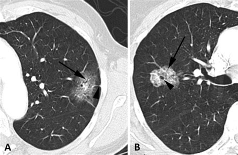 Clinicoradiographic Predictors of Aggressive Biology in Lung Cancer With Ground Glass Components ...