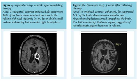 Article: Brain lesions in a patient with rectal cancer: mind your step (full text) - December ...