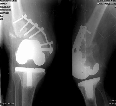 Impacted Fracture - Fracture Treatment