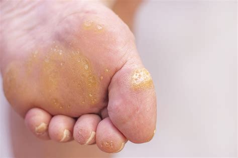 Warts on Your Feet? Symptoms & Causes of Plantar Warts - Foot and Ankle Group