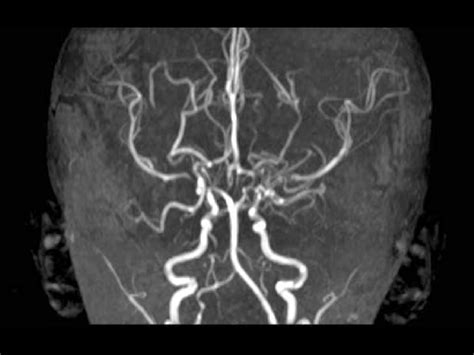 Three-dimensional (3D) magnetic resonance angiography (MRA) shows... | Download Scientific Diagram