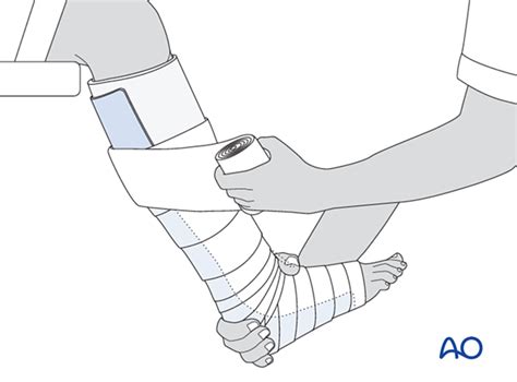 Short leg cast for Simple complete fracture of the distal tibial metaphysis